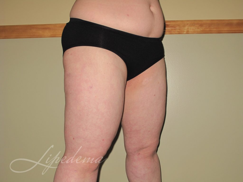 You Have Lipedema, and It Hurts.. What the Heck Are You Supposed