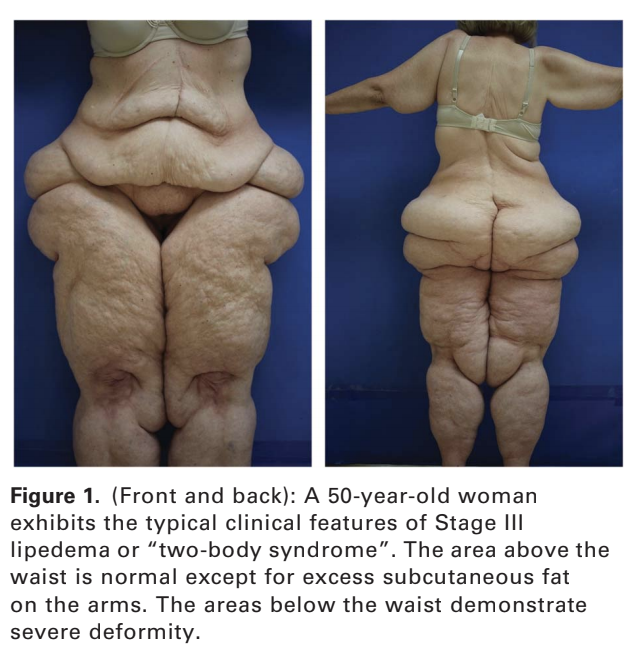 A. Excess of skin and subcutaneous tissue in abdominoplasty patient. B.