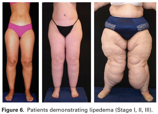 Lipedema : Symptoms, Treatment and Prevention - 2024