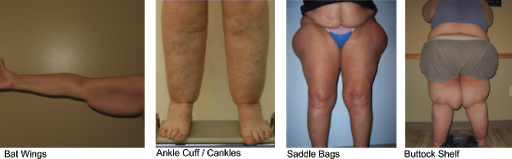 Lipedema calves