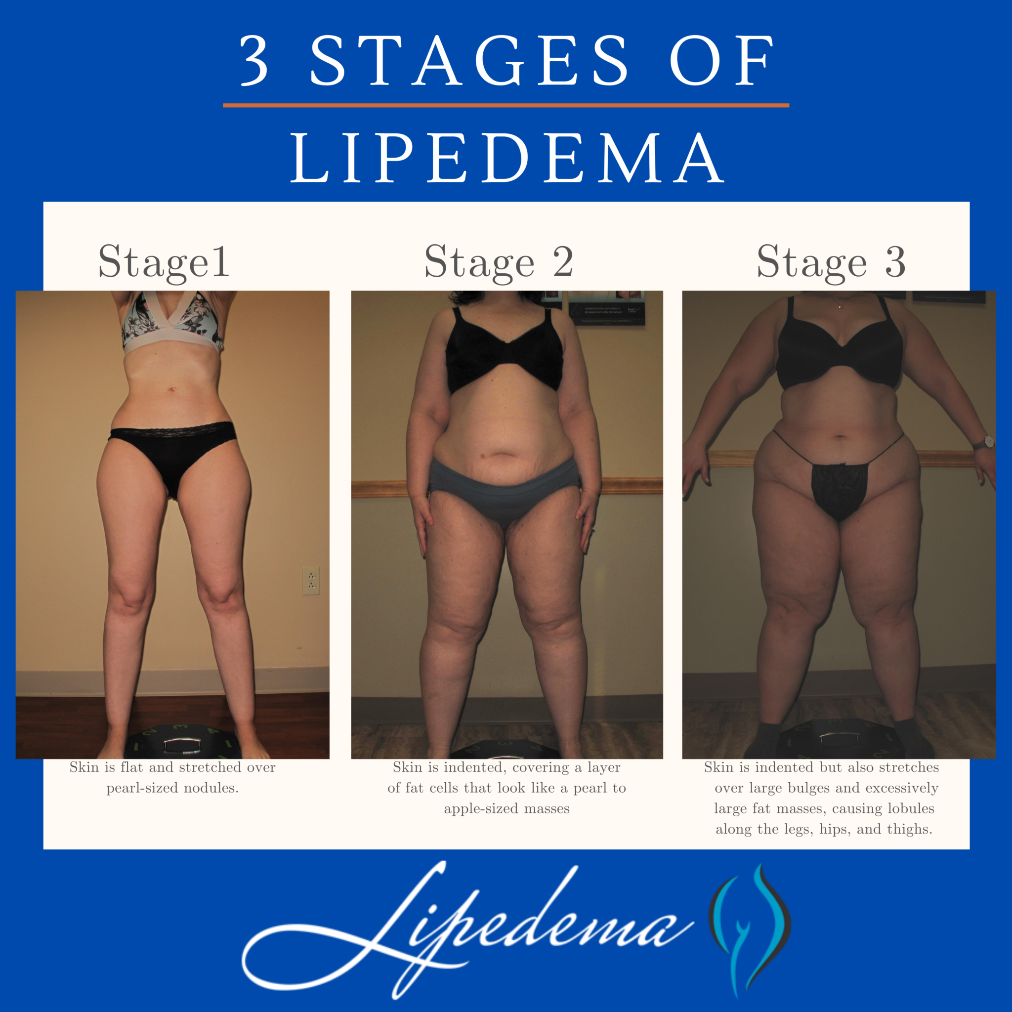 Follow These 4 Steps To A Lipedema Diagnosis Lipedema Net