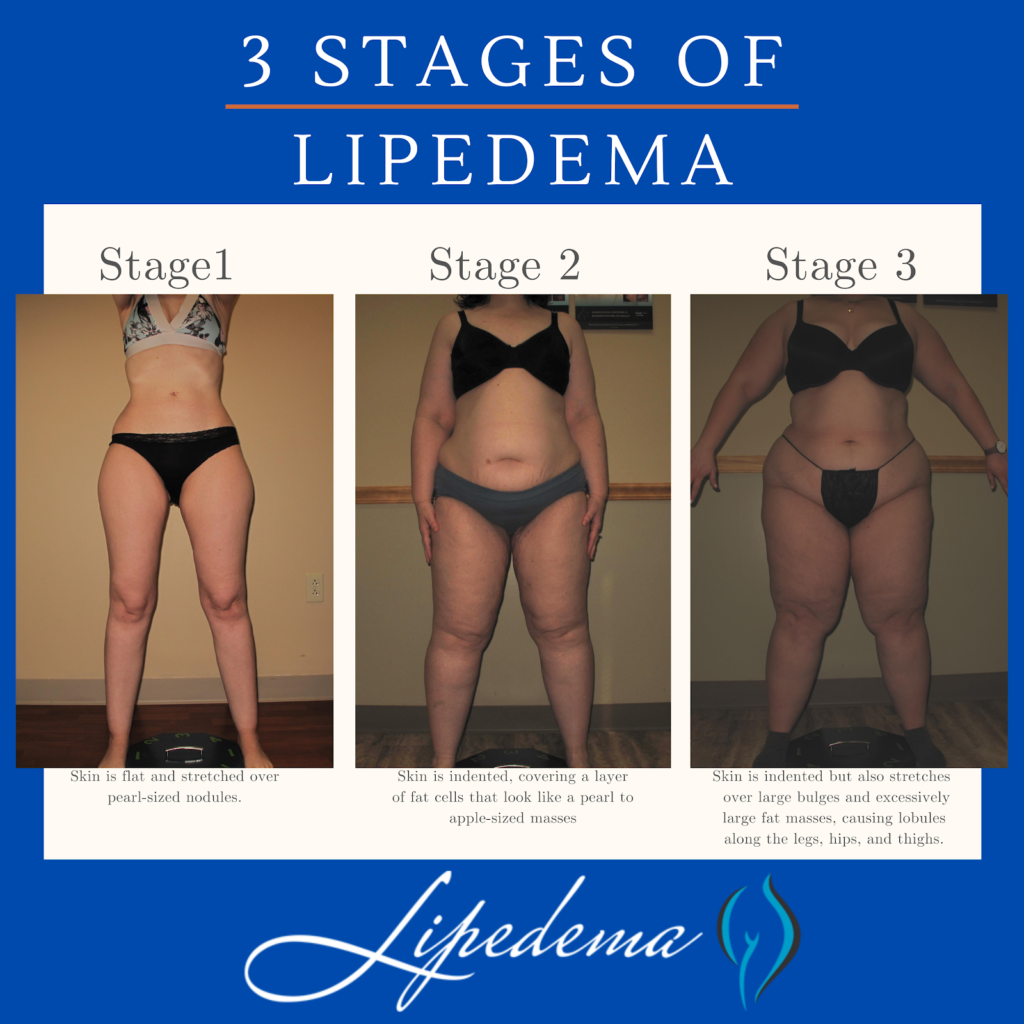 Total Lipedema Care - #BeforeandAfter Ankle Cuffs⁣ ⁣ Do you have