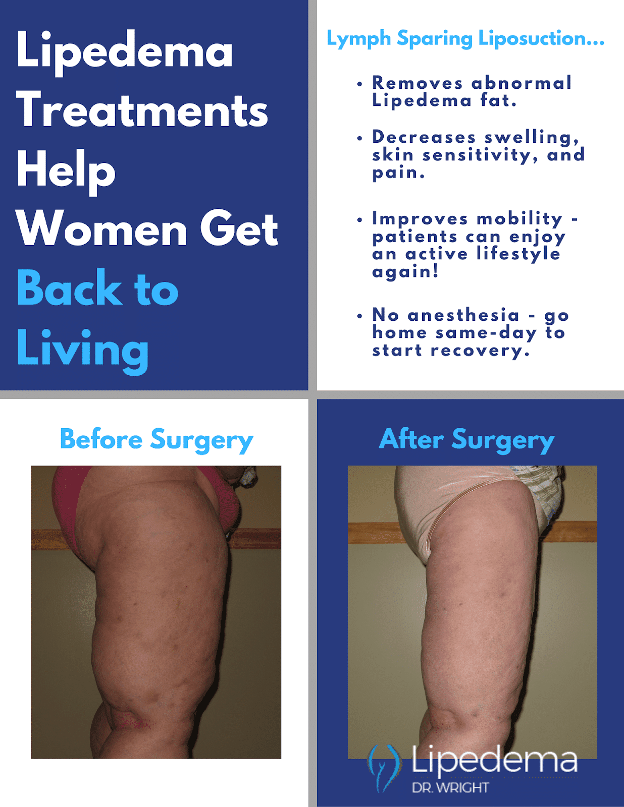 Everything You Need To Know About Lipedema Treatment Lipedemanet 