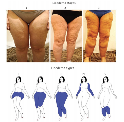 Lipedema - The Disease They Call FAT - Numerous patients with