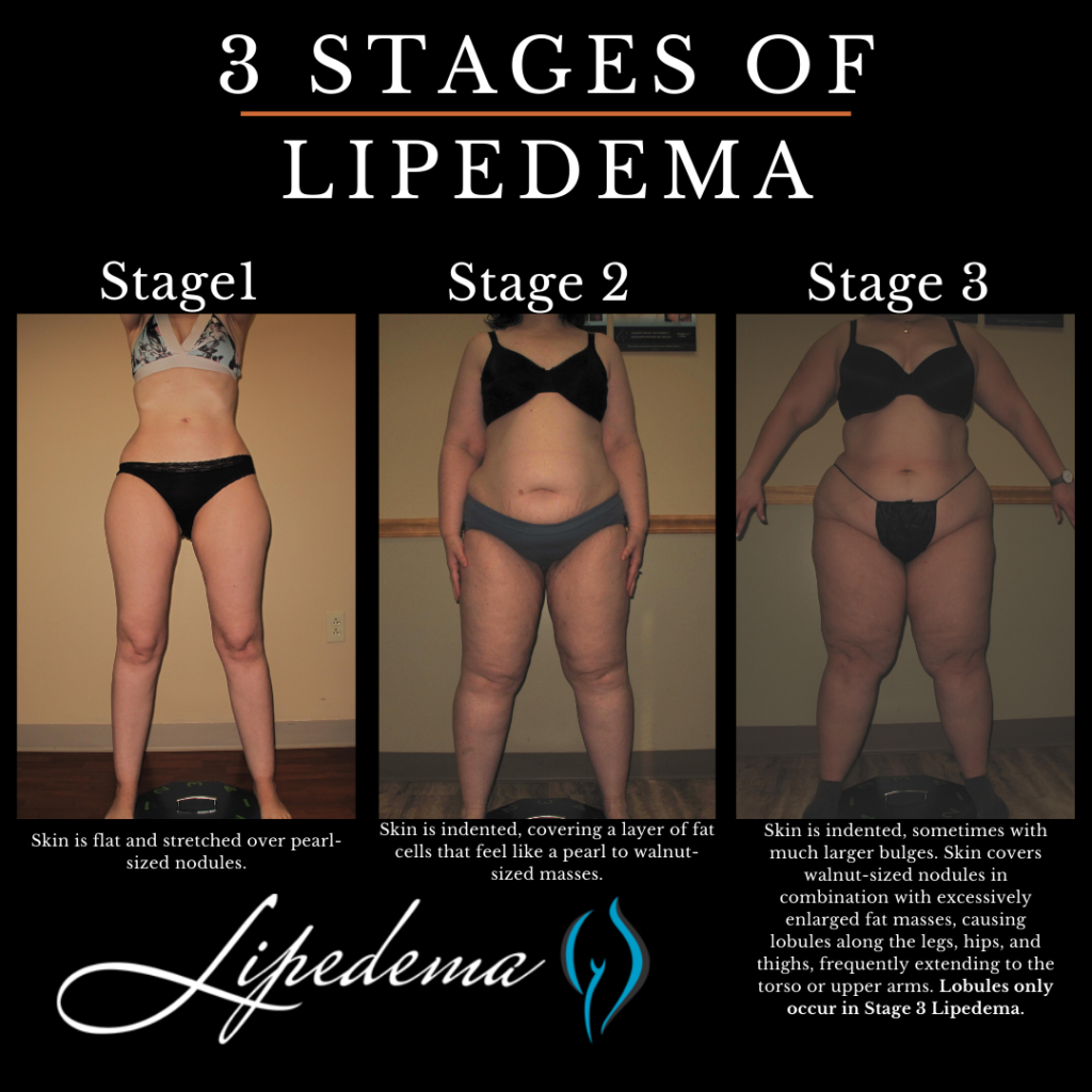 How Can I Slow the Likely Progression of My Lipedema? - Total