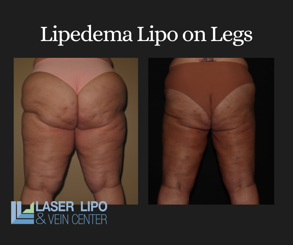 Lipedema compression garments after liposuction 