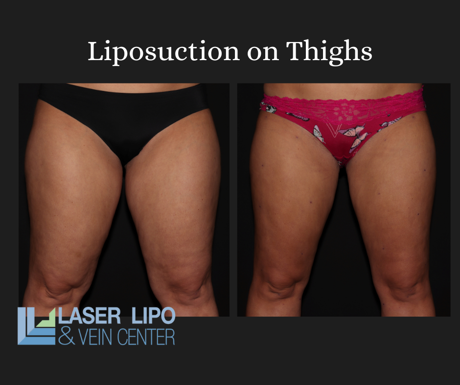 Traditional Liposuction Vs. Laser Liposuction: What's The Difference? -  Hinsdale Vein & Laser