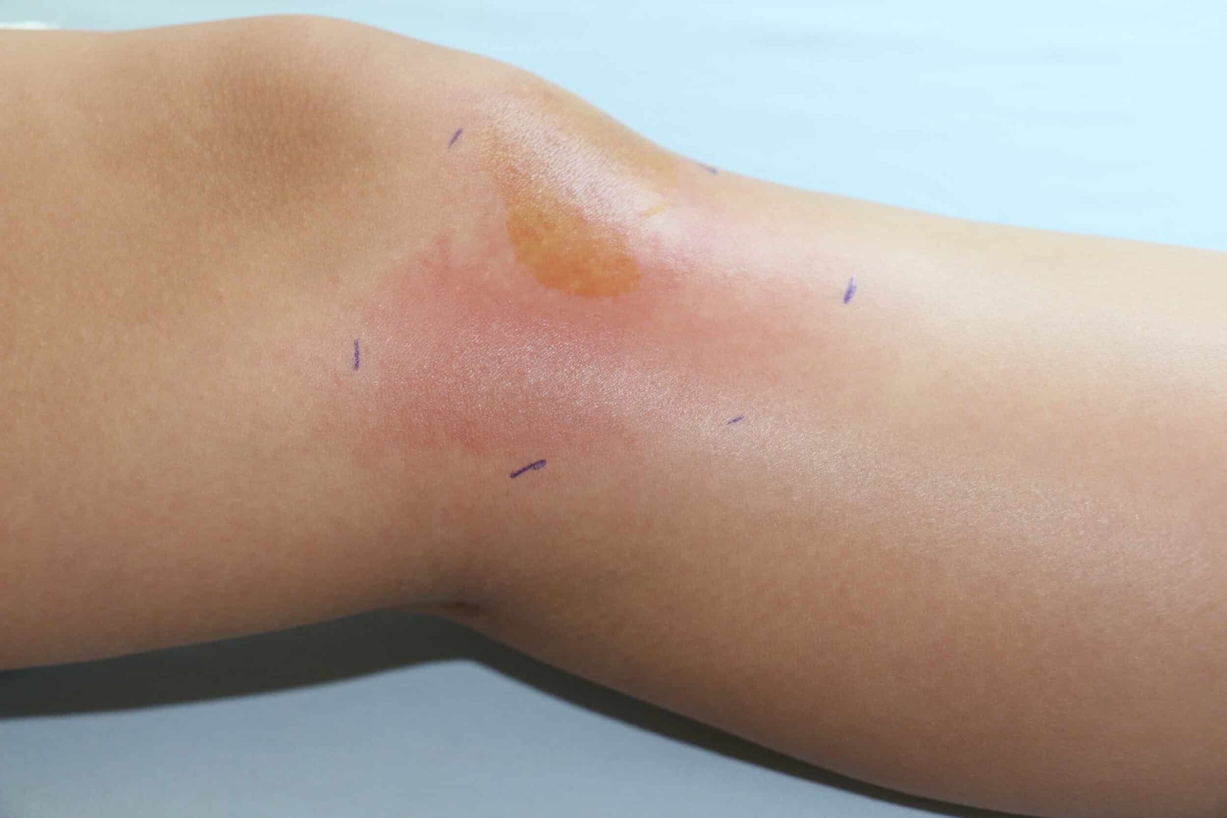 vein flow and lipedema