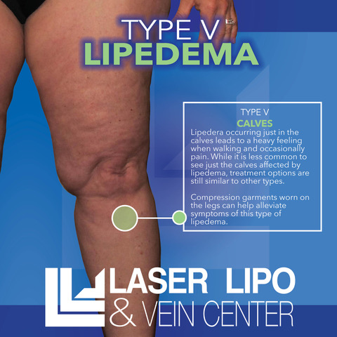 Learn About Stages and Types of Lipedema