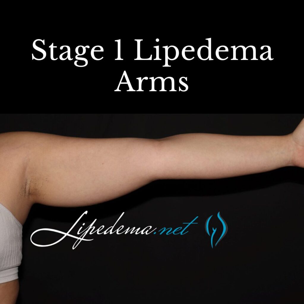 Is It Lipedema or Just Fat? Understanding Lipedema and Its Stages