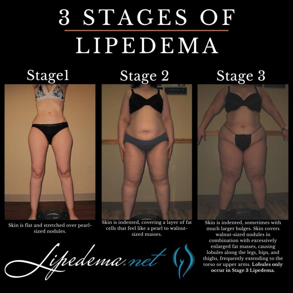 3 Stages of Lipedema
