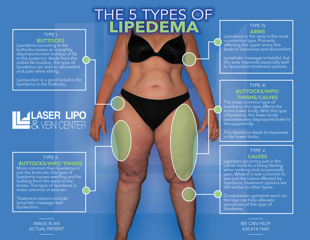 Understanding Lipedema Diagnosis And Coding A Medical Breakthrough In 