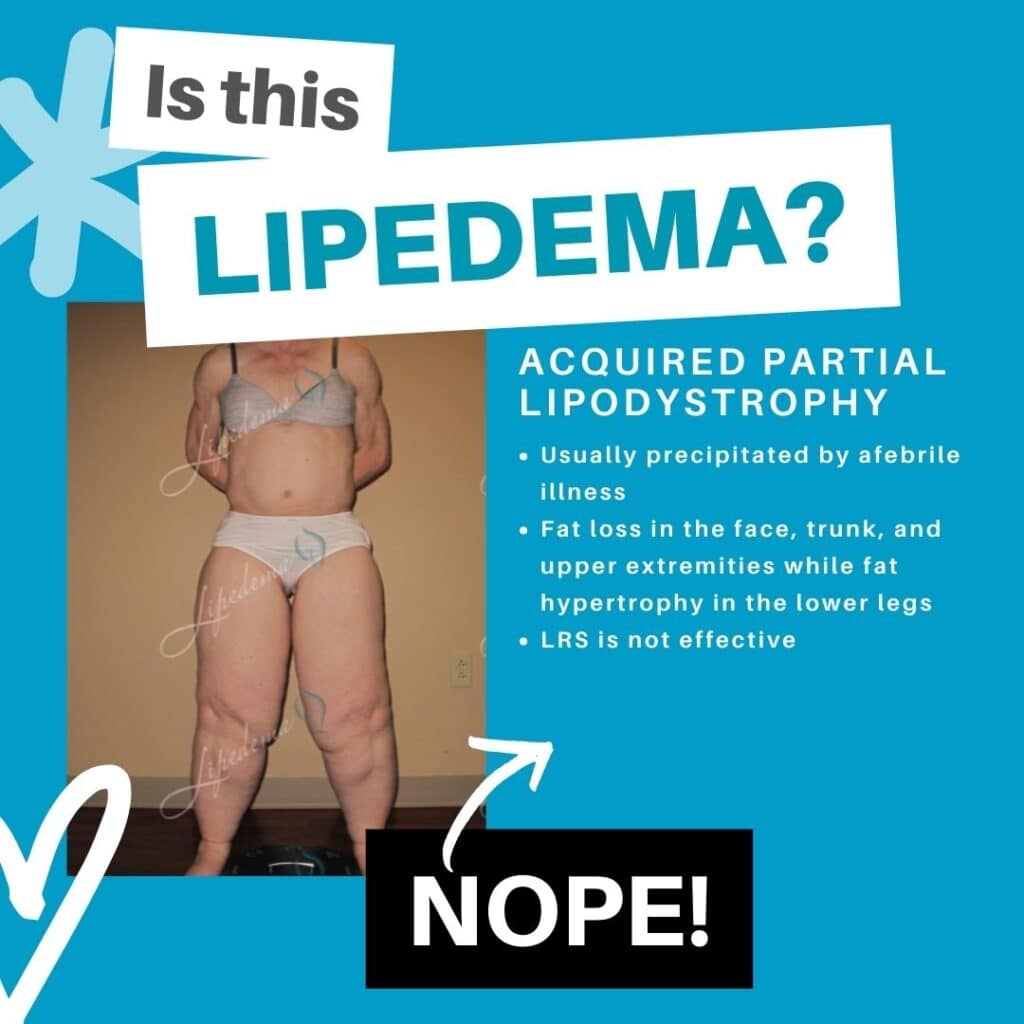 Lipedema Lookalikes St. Louis Missouri Lipedema Treatment Acquired Partial Lipodystrophy