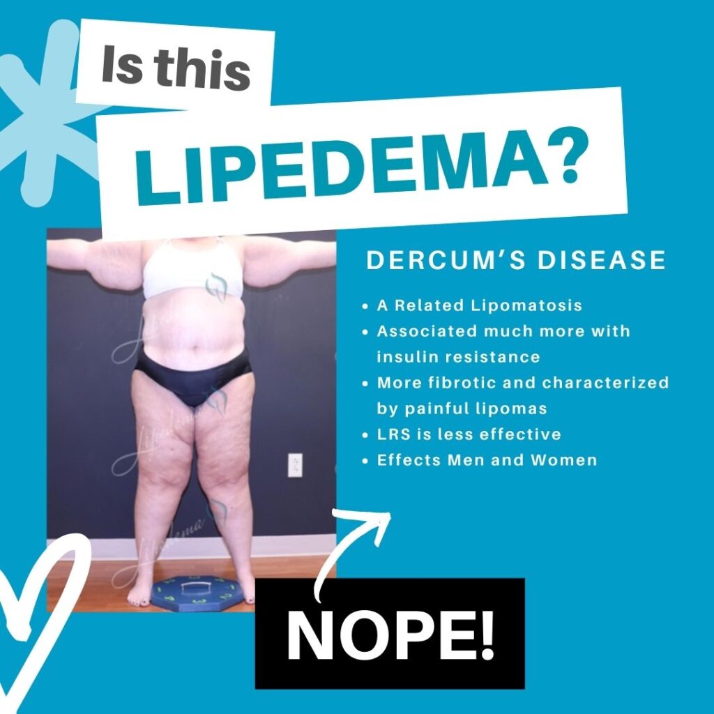 Lipedema Lookalikes St. Louis Missouri Lipedema Treatment Dercums Disease
