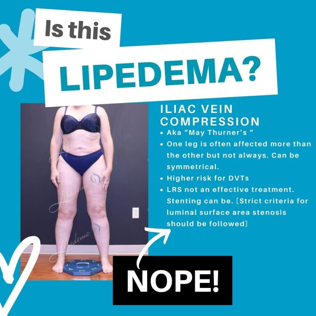 Lipedema Lookalikes St. Louis Missouri Lipedema Treatment Iliac Vein Compression
