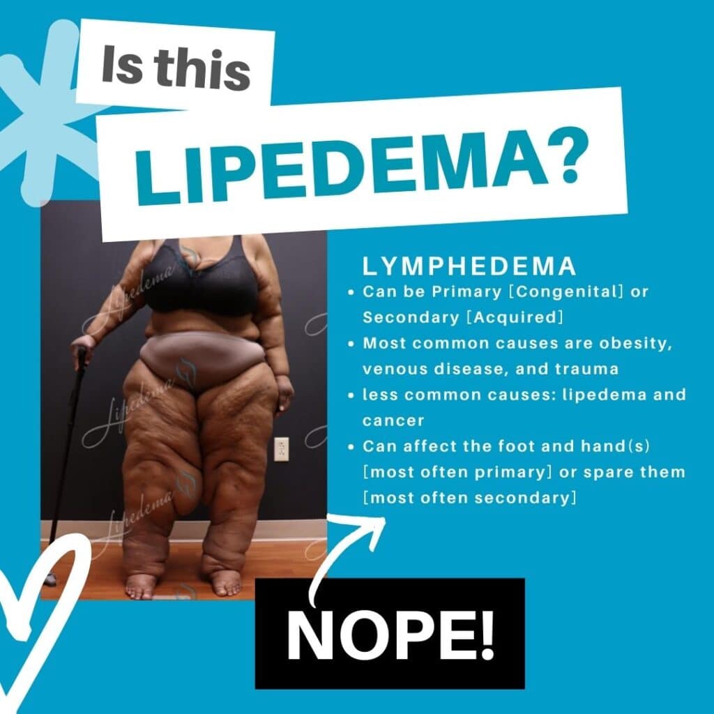 Lipedema Lookalikes St. Louis Missouri Lipedema Treatment Lymphedma