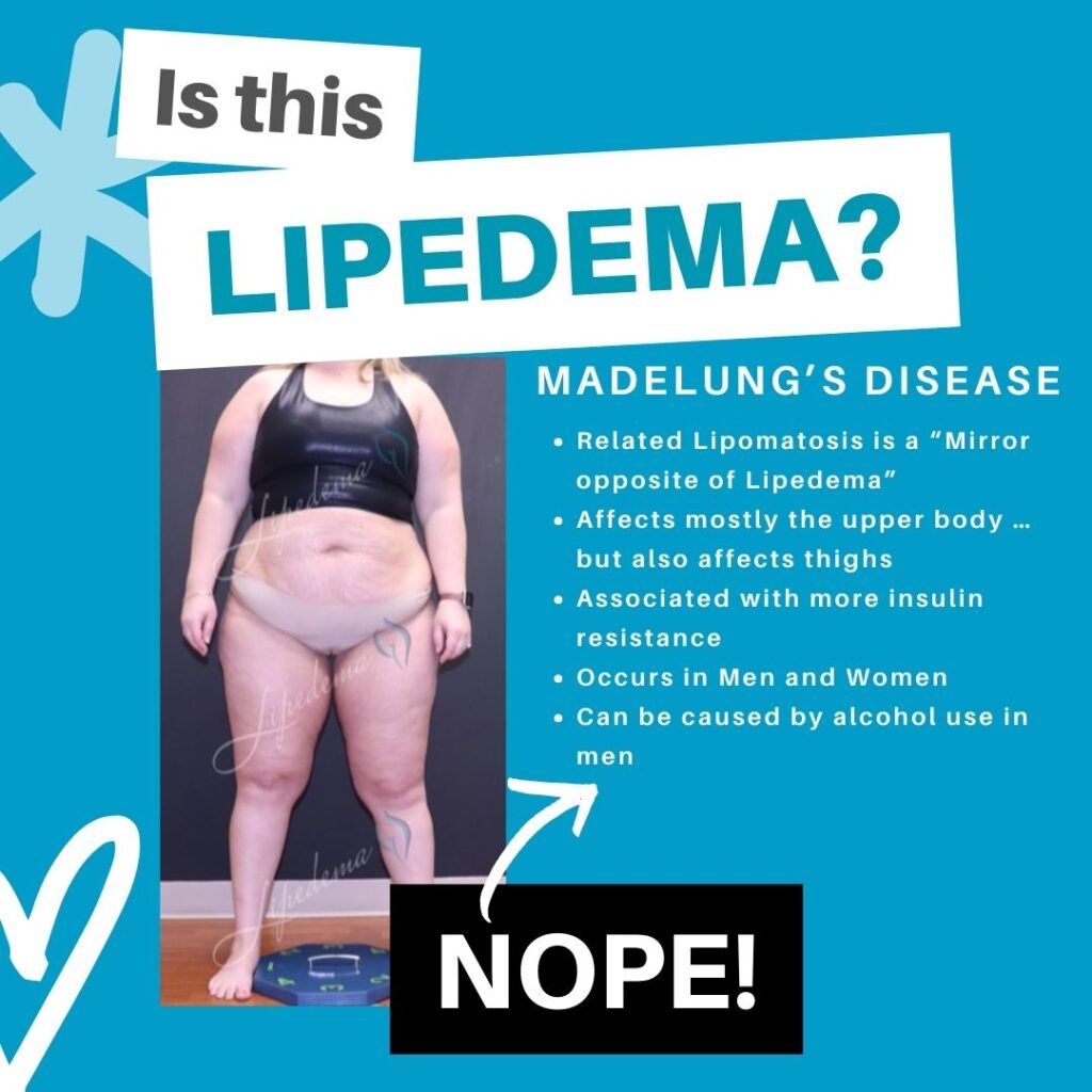 Lipedema Lookalikes St. Louis Missouri Lipedema Treatment Madelungs Disease