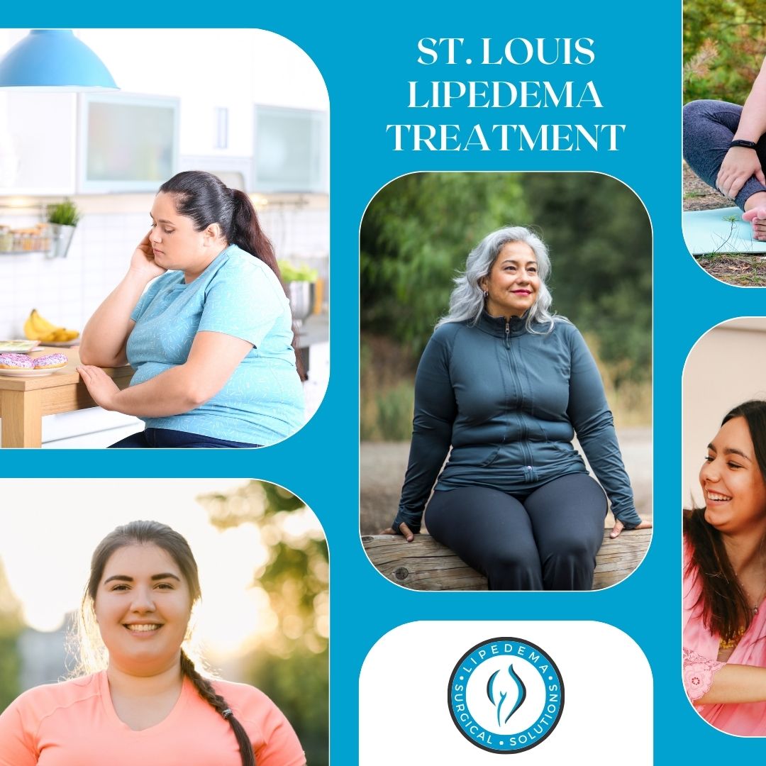 St. Louis Lipedema Treatment Your Guide to Finding the Right Specialist in Missouri St. Louis Lipedema Treatment Your Guide to Finding the Right Specialist in Missouri
