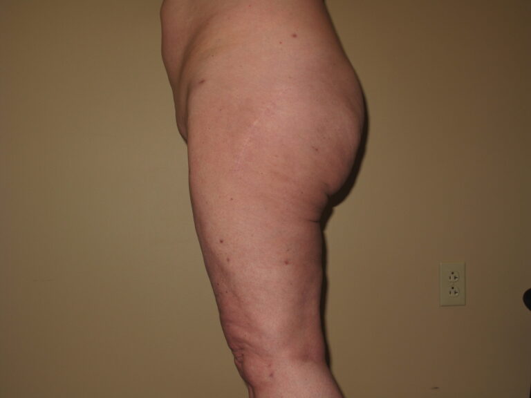 After Image: Butt - left-side