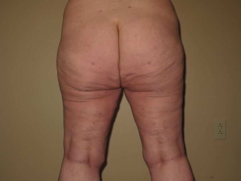 After Image: Butt - back