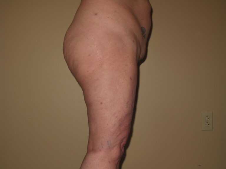 After Image: Butt - right-side