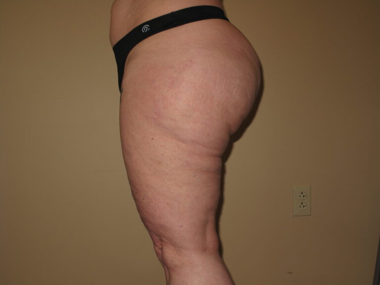 Before Image: Butt - left-side