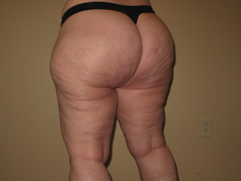 Before Image: Butt - left-back-oblique