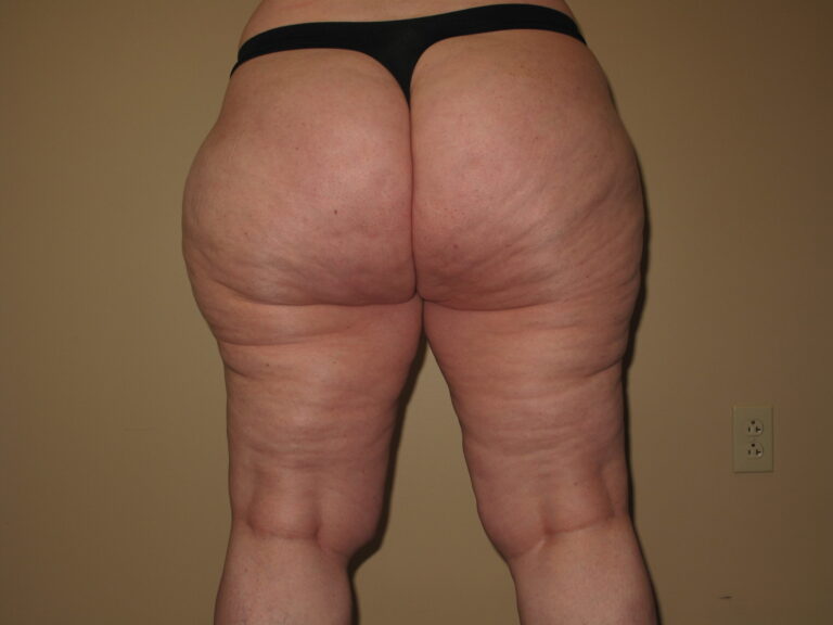 Before Image: Butt - back
