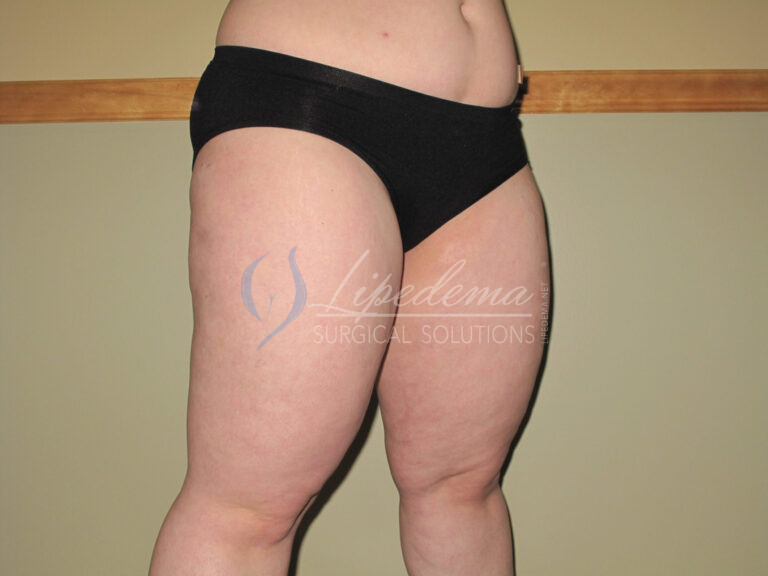 Before Image: Stage 2 - right-front-oblique