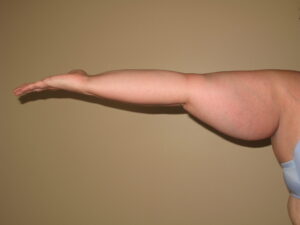 Before Image: Stage 2