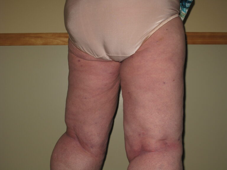 After Image: Thighs - right-back-oblique