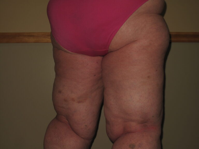 Before Image: Thighs - right-back-oblique