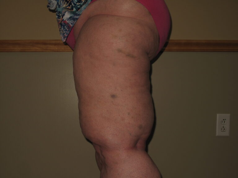 Before Image: Thighs - left-side