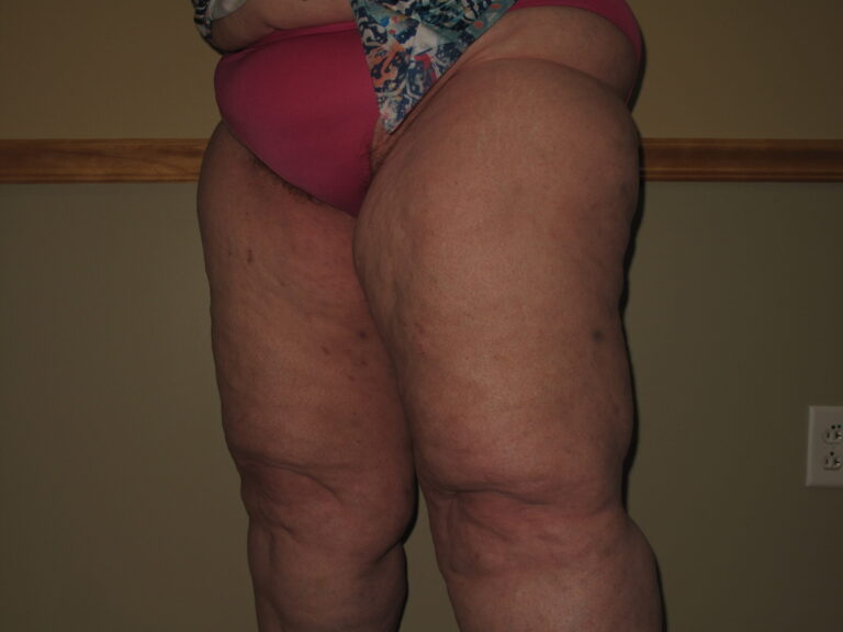 Before Image: Thighs - left-front-oblique