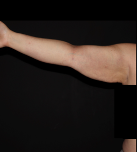 After Image: Stage 3