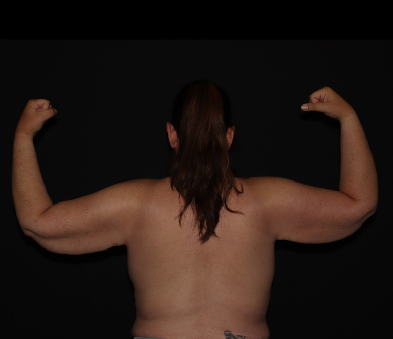 After Image: Stage 3 - back
