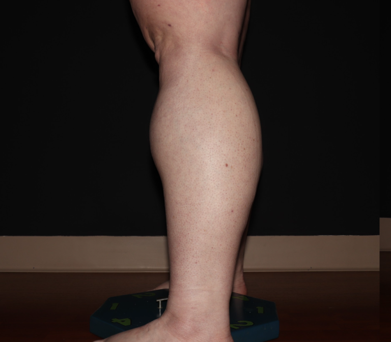 Before Image: Stage 3 - left-side