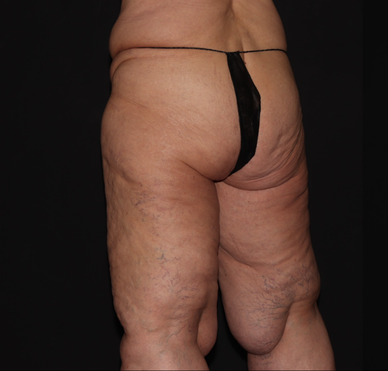 Before Image: Stage 3 - left-back-oblique