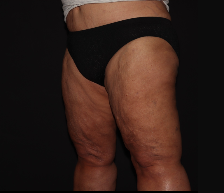 After Image: Stage 3 - left-front-oblique