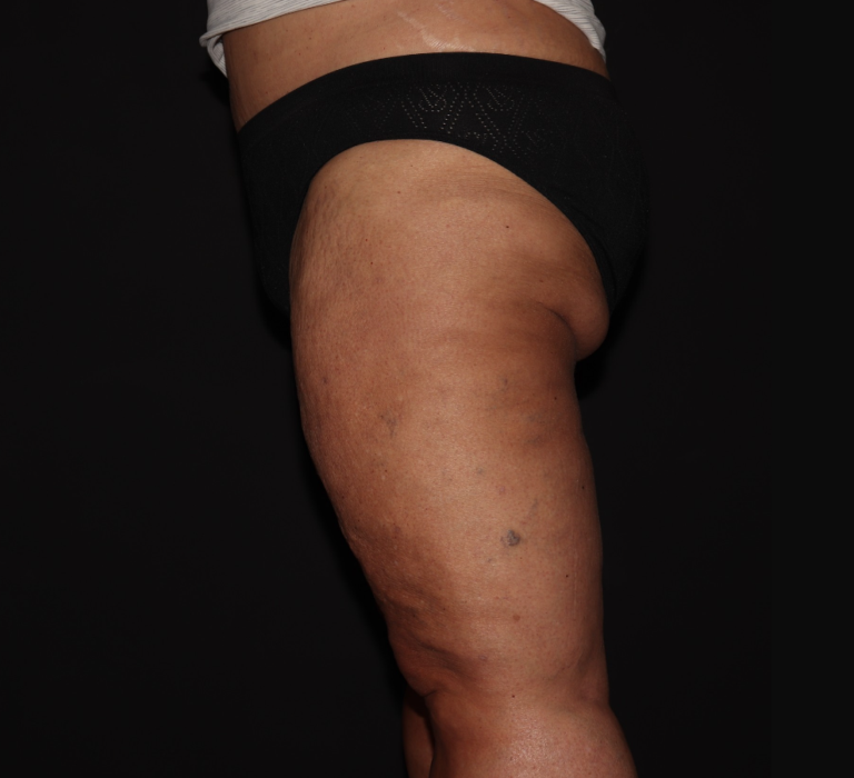 After Image: Stage 3 - left-side