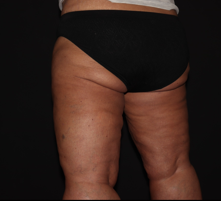 After Image: Stage 3 - left-back-oblique