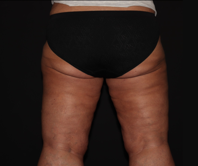 After Image: Stage 3 - back
