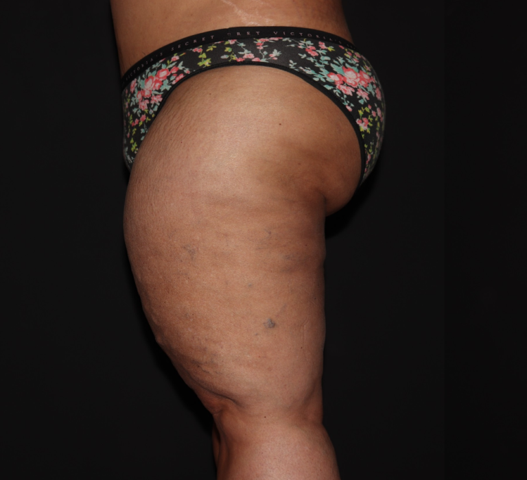Before Image: Stage 3 - left-side