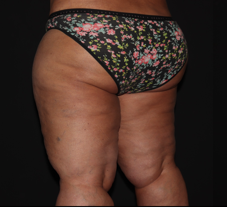 Before Image: Stage 3 - left-back-oblique