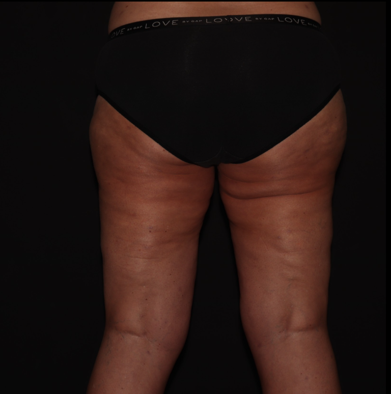 After Image: Stage 3 - back