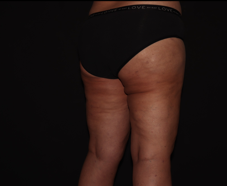 After Image: Stage 3 - right-back-oblique