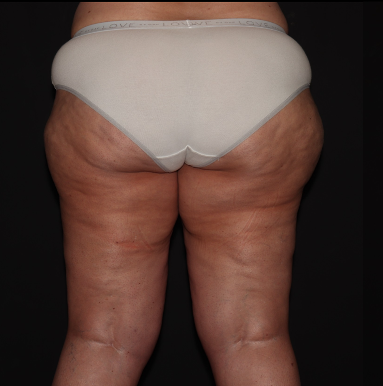 Before Image: Stage 3 - back