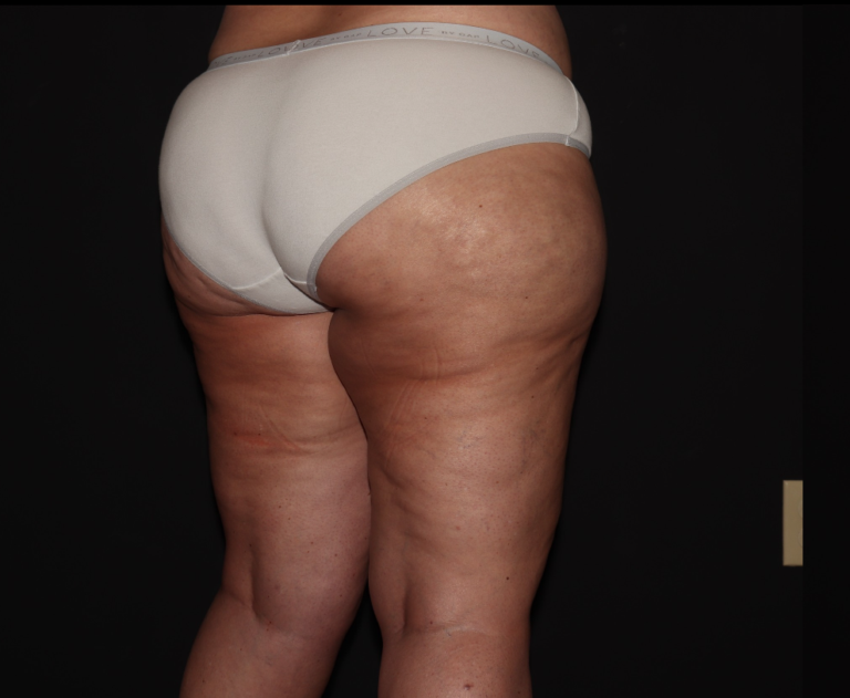 Before Image: Stage 3 - right-back-oblique
