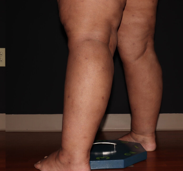 After Image: Stage 3 - left-back-oblique