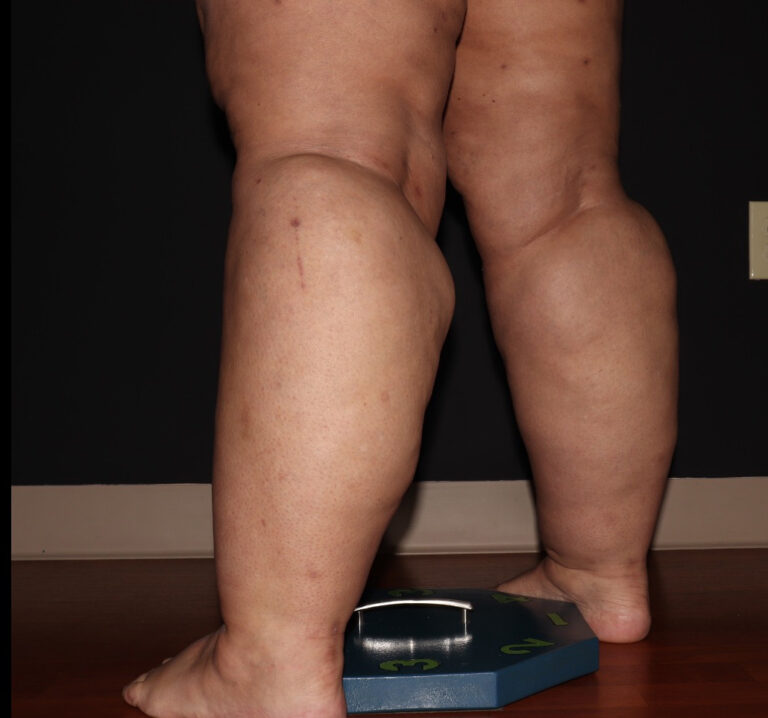 Before Image: Stage 3 - left-back-oblique